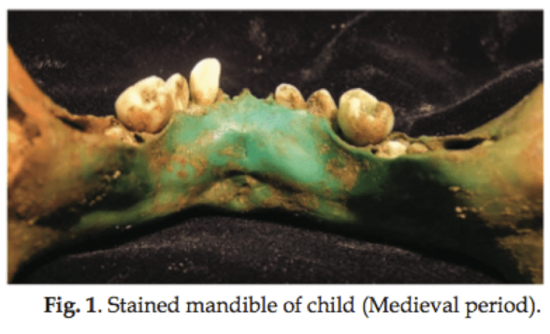 Värjäytyneet_luut1