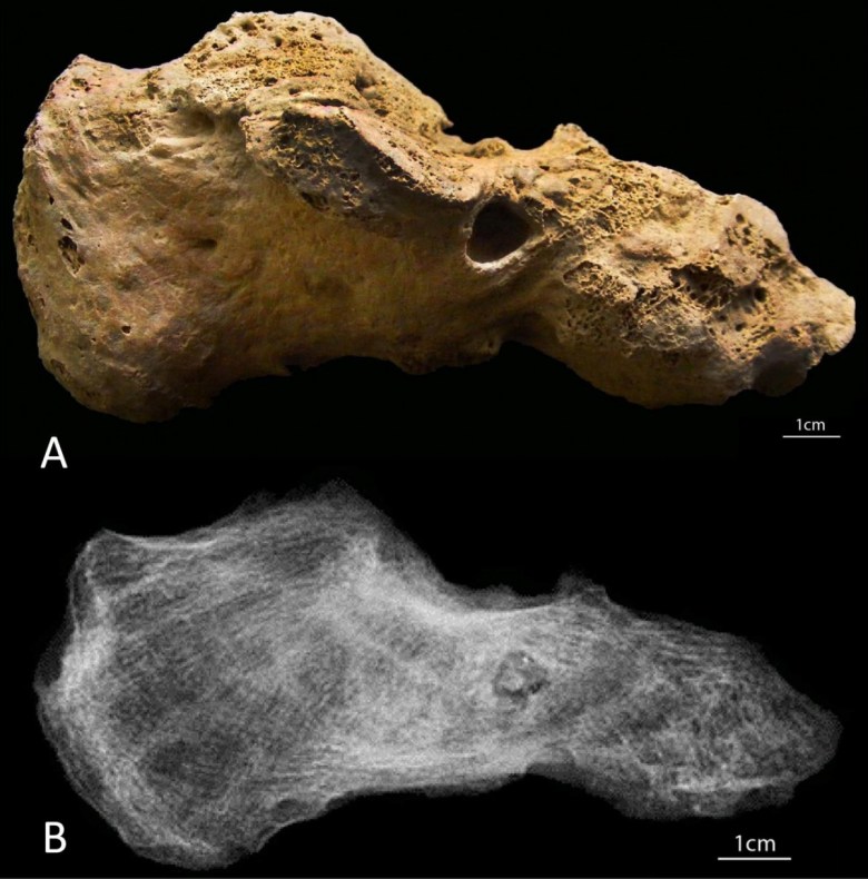 Keskiaikaiselta portugalilaiselta hautausmaalta löytynyt vainaja kärsi trooppisen jalkasienen aiheuttamasta luuvauriosta (Kuva: Curto & Fernandes 2016, fig. 1.)