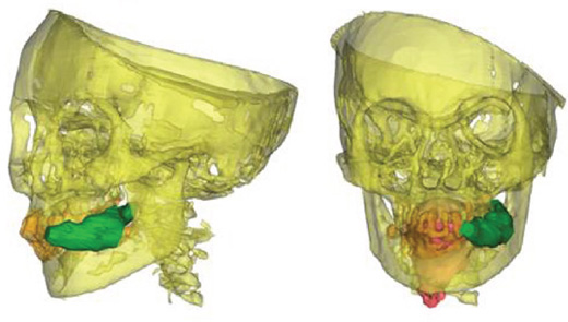 Llullaillacosta löytyneen, Juanitana tunnetun muumion tietokonetomografiakuvassa näkyy, kuinka uhrin suussa on vieläkin kokapensaan lehtiä.